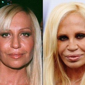 plastic surgery fail 1