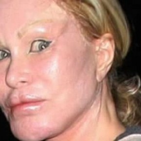 plastic surgery fail 18