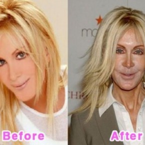 plastic surgery fail 4