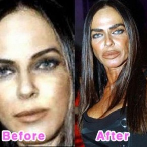 plastic surgery fail 5