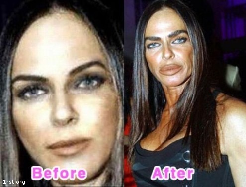 plastic surgery fail 5