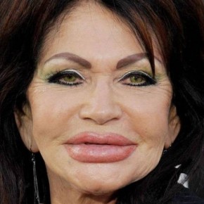 plastic surgery fail 8